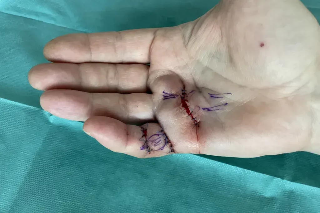 Dupuytren OP Erfahrungen: Hand am Tag nach der Operation mit feinen Nähten in den Beugefalten