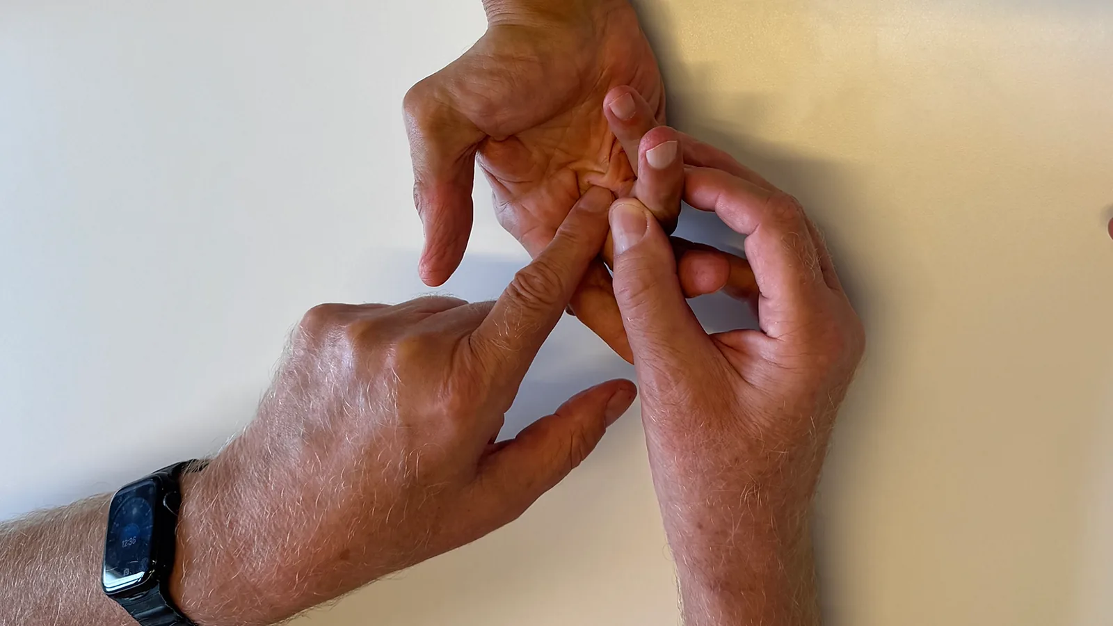 Prof. Reichert untersucht einen Patienten mit einer Dupuytren Kontraktur