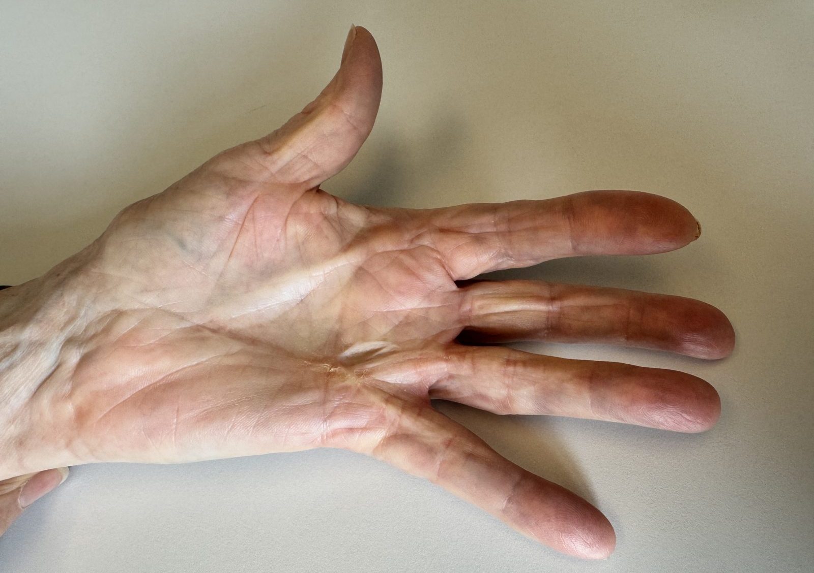 Neuer Kontrakturstrang über dem Zeigefingerstrahl bei Morbus Dupuytren nach früherer Operation