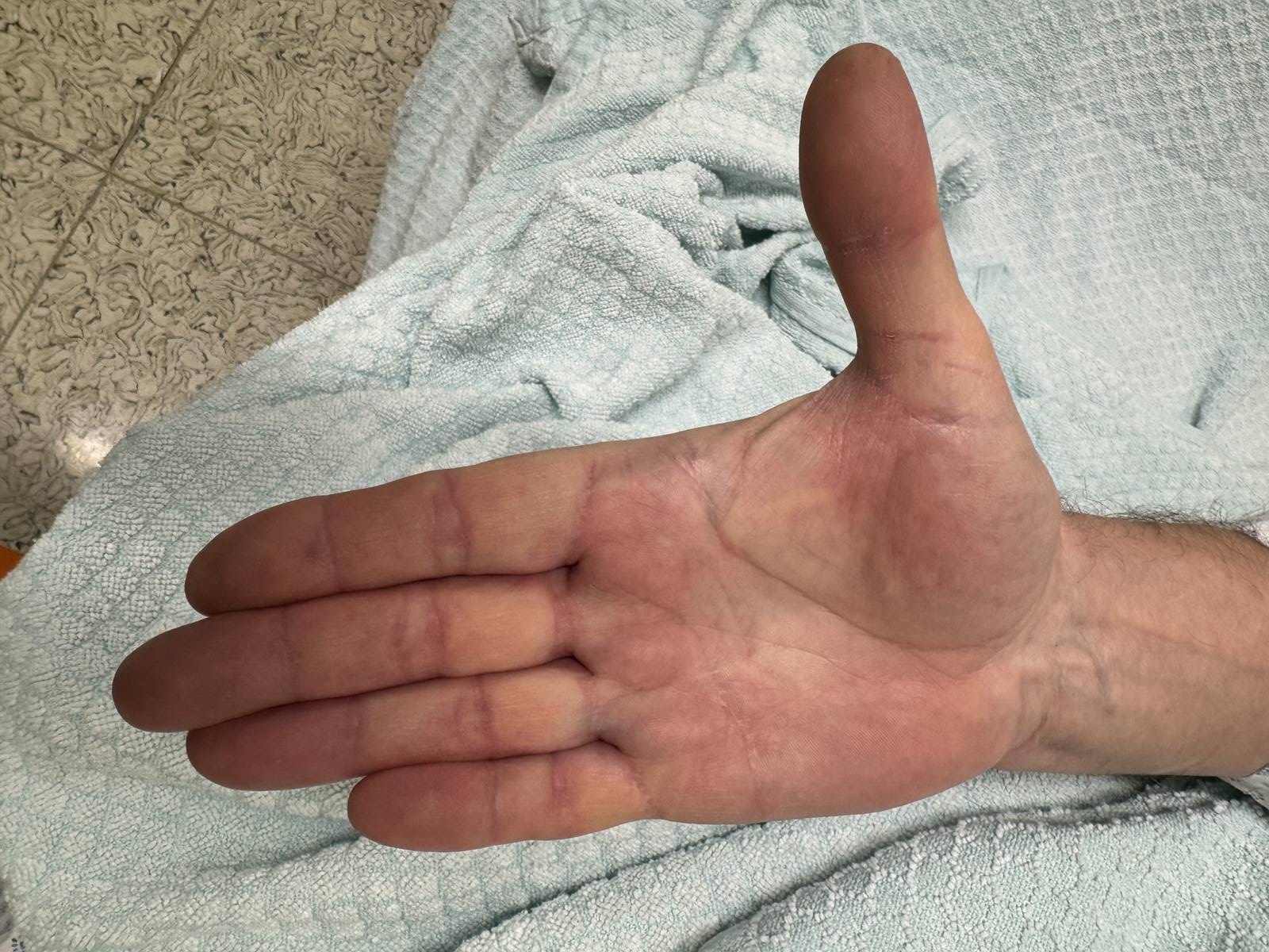 Narben nach Dupuytren-Operation – Handinnenfläche drei Jahre nach dem Eingriff, kaum sichtbar